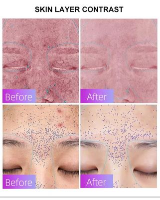 kaufen Blue Light Acne Treatment Mask with Intelligent Timer – Manufacturer Direct Supply, Appearance Patent Included on-line-Fertigung